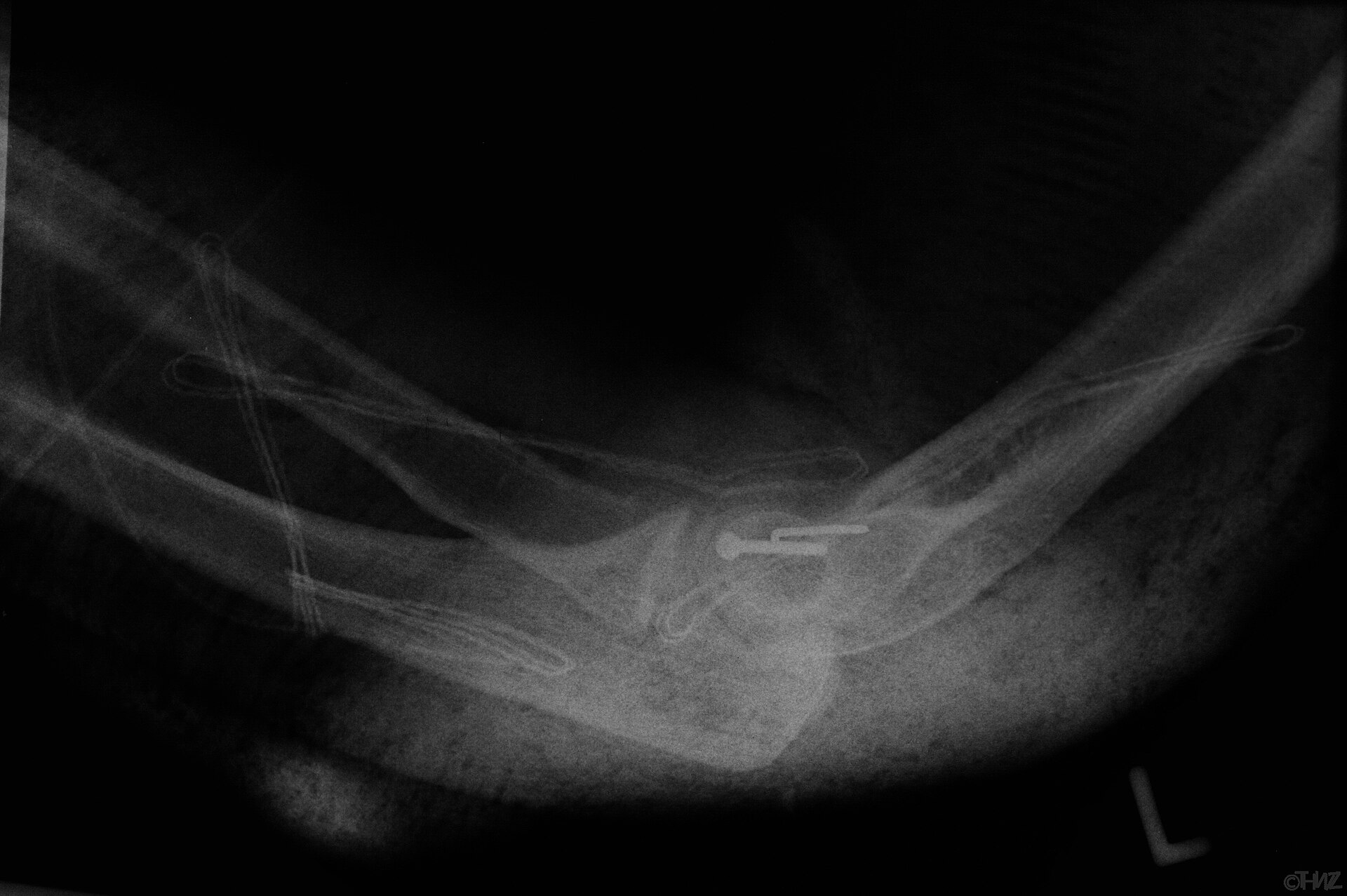 Radiografía de una fractura – Traumatólogos y Ortopedistas en Oaxaca